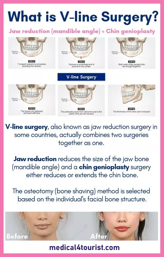 جراحی تراشیدن چانه به وسیله تخصصی‌ها انجام می‌شود و ممکن است شامل کاهش حجم استخوان فک، لیپوساکشن چهره، و حتی جراحی چانه باشد تا به دستیابی به شکل دلخواه چهره کمک کند.