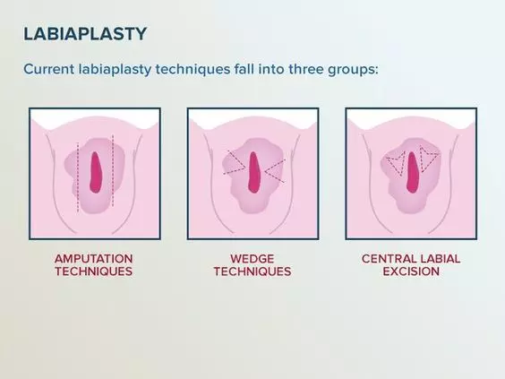 لابیاپلاستی در اصل یک روش زیبایی است، اما در بیشتر موارد، این جراحی برای زنانی در نظر گرفته می‌شود که به بلوغ جنسی رسیده‌اند