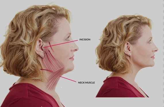 این مقاله به تفصیل در مورد فواید و نتایج جراحی لیفت صورت و جوانسازی صورت صحبت می‌کند.