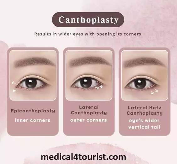 در جراحی کانتوپلاستی، ابتدا از طریق برش‌های جراحی در منطقه چشم، زاویه کانتال تغییر می‌کند. سپس با دوختن بافت‌ها و تنظیم زاویه‌ها، شکل چشم به نحو مطلوبی تغییر می‌یابد.