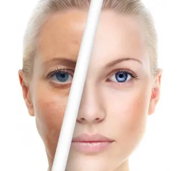 نانوفت صورت، یک روش غیرجراحی برای جوان‌سازی صورت است که باعث بهبود ظاهر پوست می‌شود.