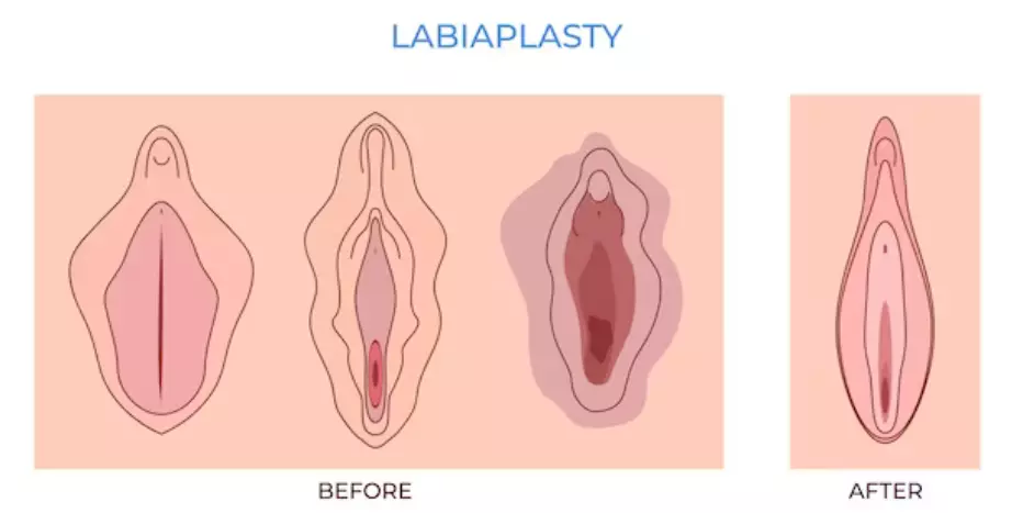 عمل لابیاپلاستی به بهبود ظاهر و راحتی منطقه تناسلی زنان کمک می‌کند.