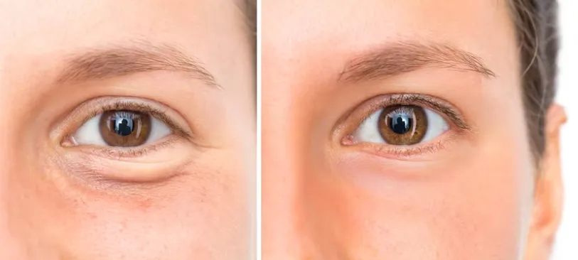 جراحی بلفاروپلاستی برای حذف اضافه‌های پوستی و بازسازی شکل طبیعی چشم‌ها انجام می‌شود.