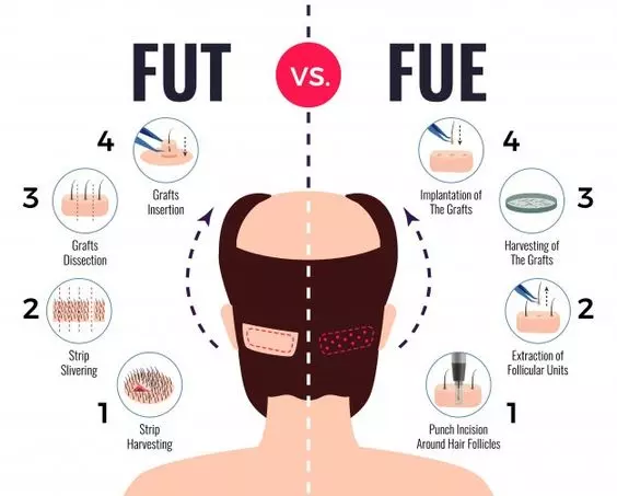 کاشت مو با روش FUE از طریق برداشت موهای فرد یک به یک، در حالی که FUT از قطعه‌های بزرگتر پوست به دست می‌آورد، دو روش متفاوت برای افزایش تعداد موهای کاشته شده با توجه به نیازهای فرد فراهم می‌آورند.